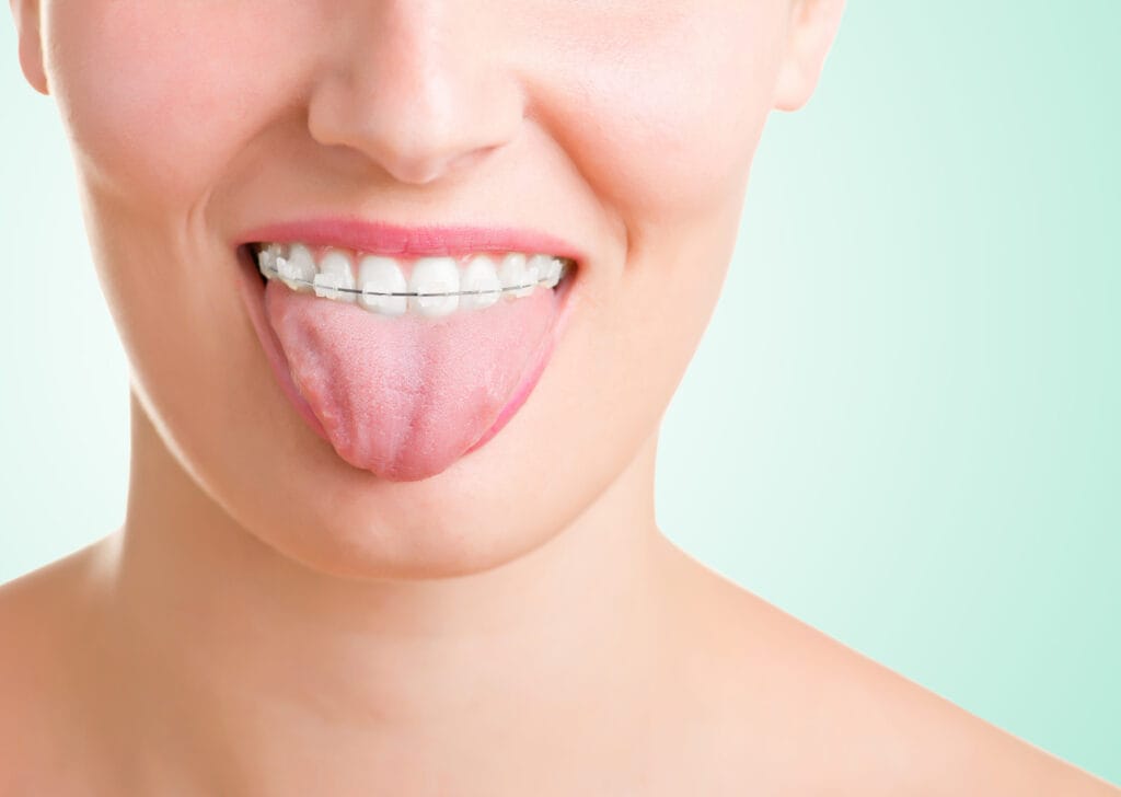 brackets de zafiro