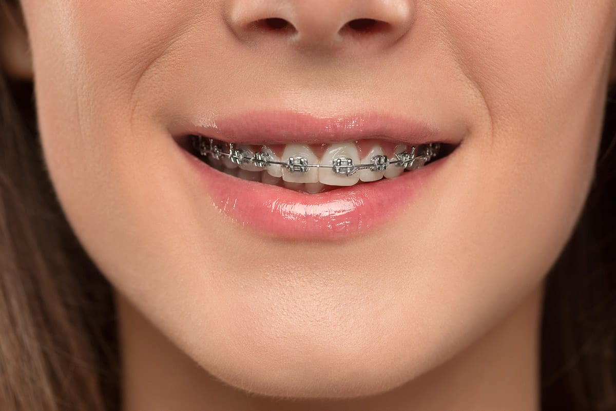 brackets metálicos