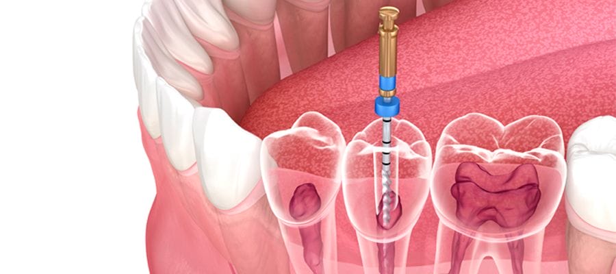 endodoncia-obturación
